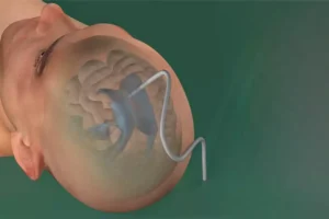 Rhovica Neuroimaging SoNav solution