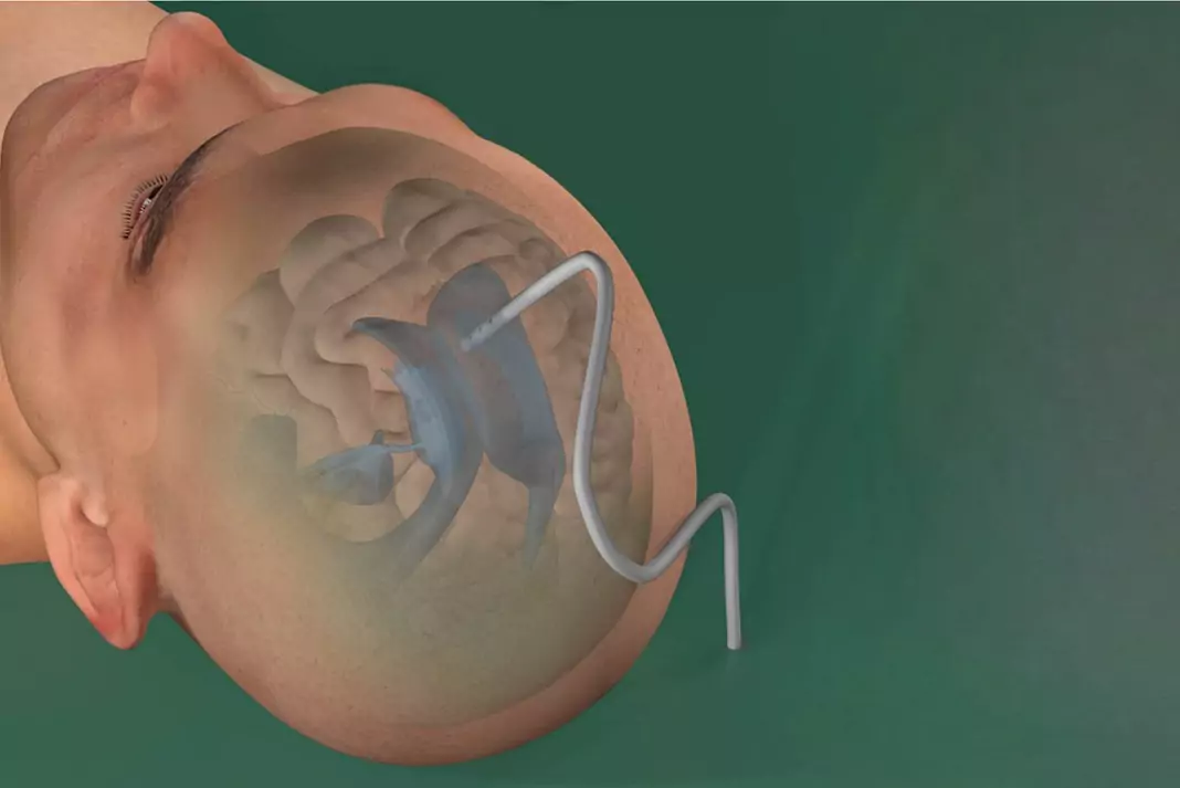 Rhovica Neuroimaging SoNav solution